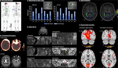 Case Report: A Neuro-Ophthalmological Assessment of Vision Loss in a Pediatric Case of McCune-Albright Syndrome